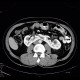 Horseshoe kidney: CT - Computed tomography